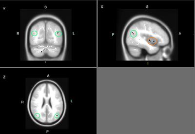 Short-Term Internet-Search Training Is Associated with Increased Fractional Anisotropy in the Superior Longitudinal Fasciculus in the Parietal Lobe